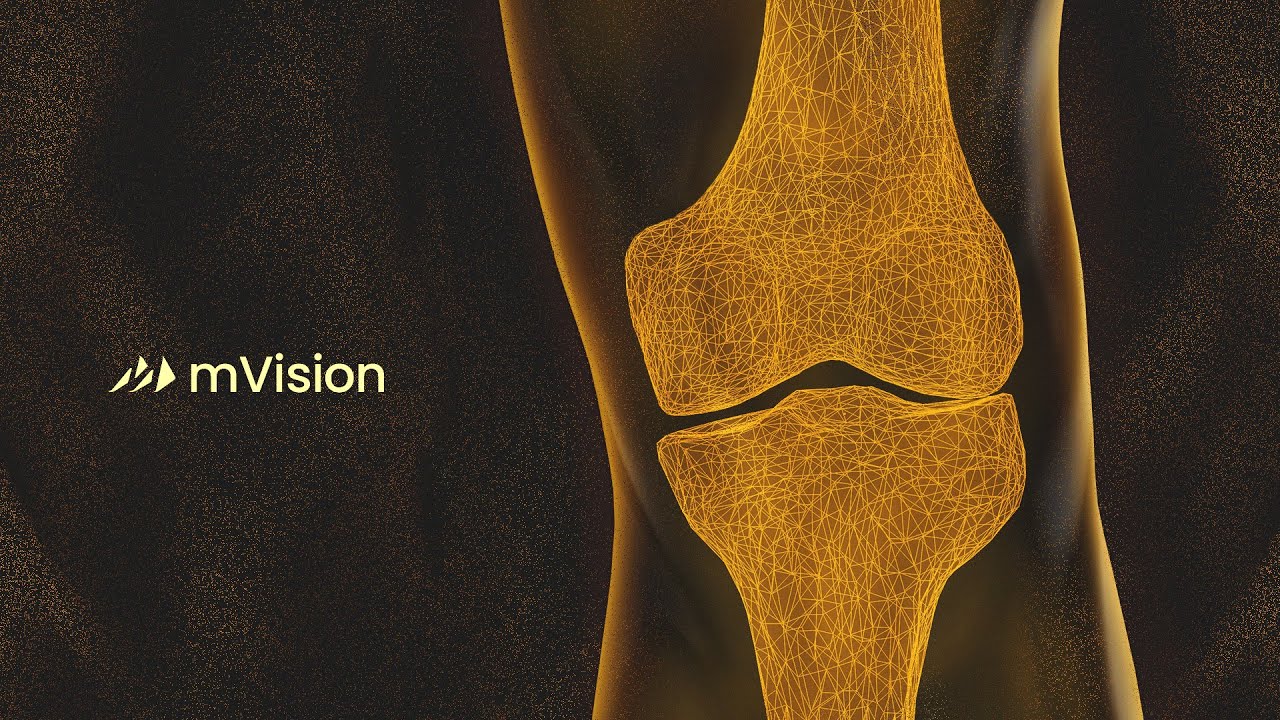 Monogram mVision surgical planning visualisation of a knee